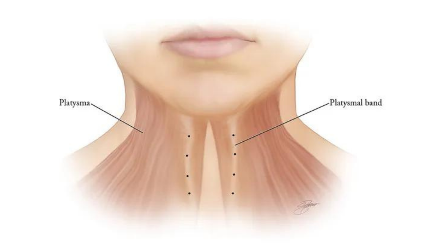 Platysmal bands toxin neck lift injection training online course