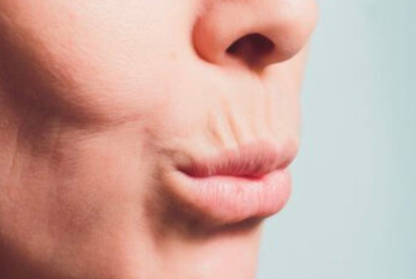 CPD course online smokers line- smokers line around mouth on woman before aesthetics 