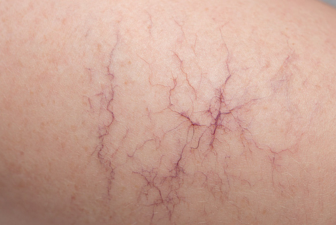 MicroSclerotherapy | CPD accredited |Online Course| Estetica Training