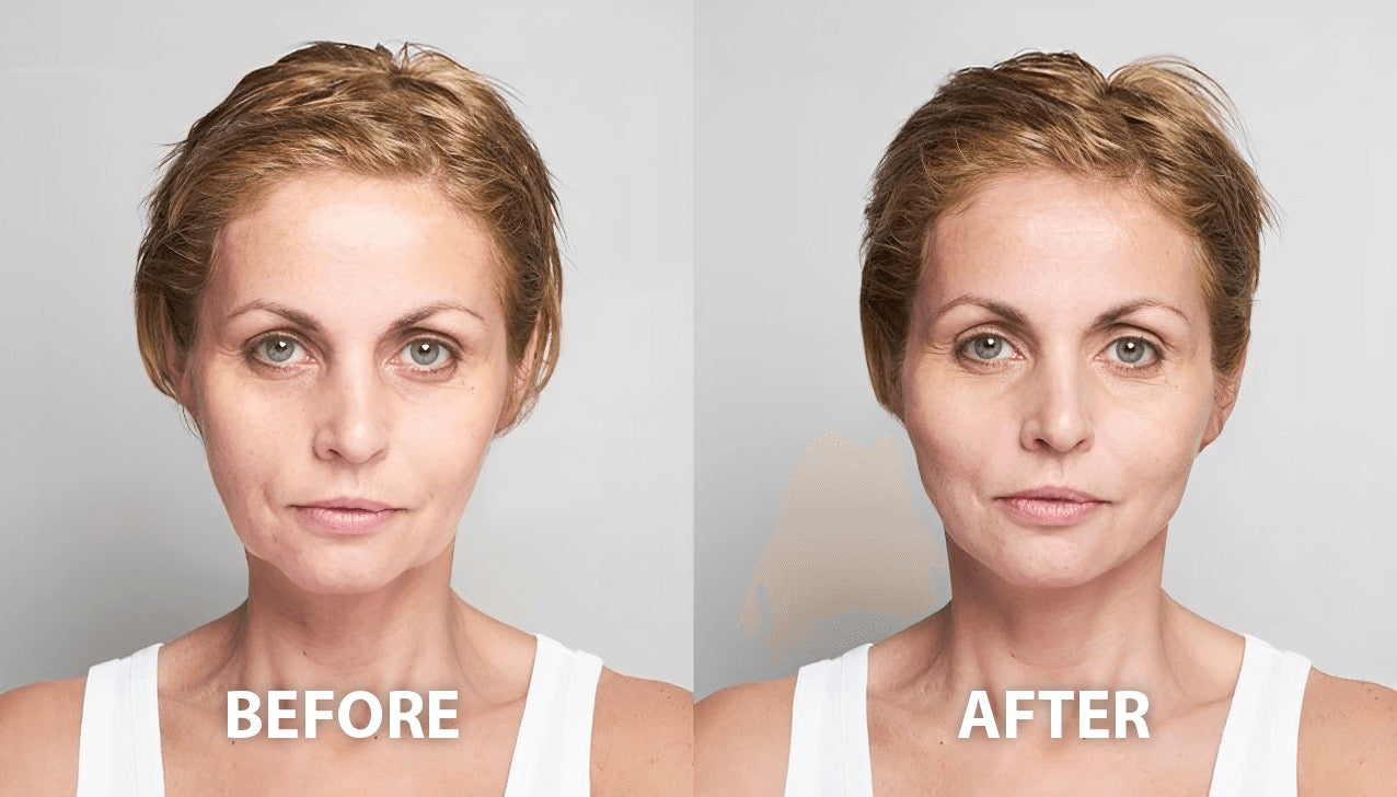 Patient results from DAO Botox injections for drooping mouth corners in CPD-accredited online course